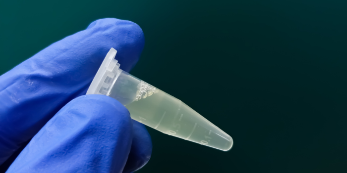 Descubren en Europa un biomarcador clave para el diagnóstico precoz del párkinson