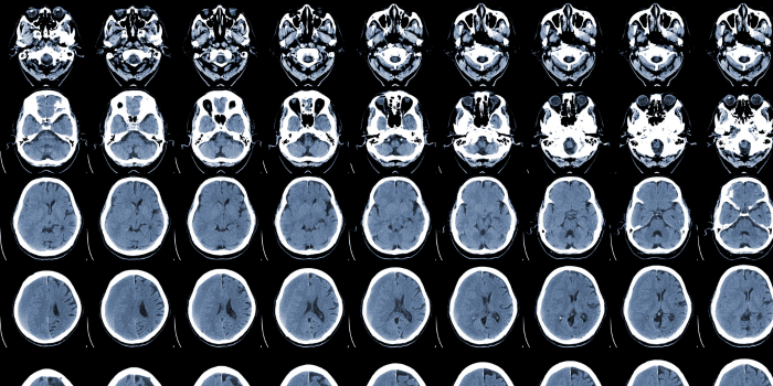 La estimulación cerebral personalizada revoluciona la marcha en pacientes con Parkinson
