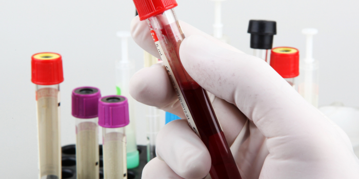 Un análisis de sangre podría ayudar a detectar el párkinson hasta 15 años antes de los primeros síntomas